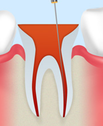 歯の神経を取る抜髄（根管充填）