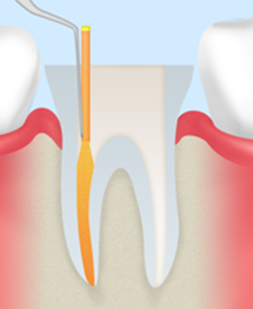 感染根管治療（歯根の治療）