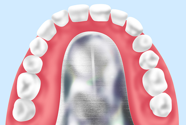 コバルトクロム床（金属床義歯）