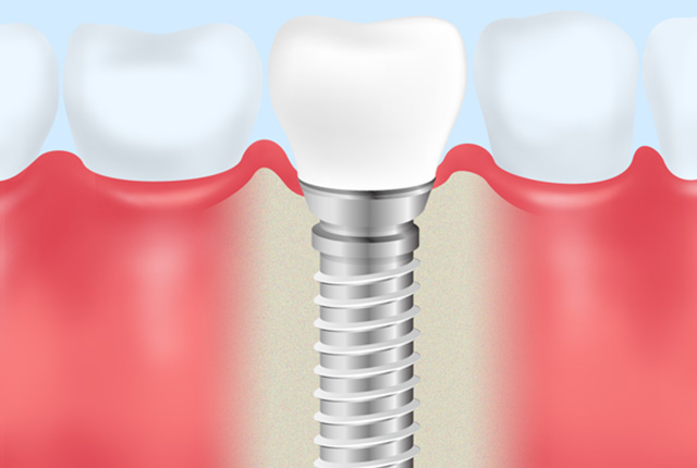 インプラント