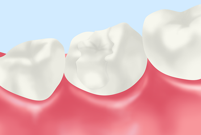 充填治療（むし歯治療） 〜CR・インレー・クラウン〜 ｜姫路市の歯医者「山田歯科医院」