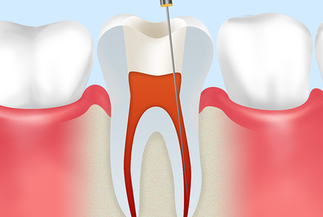 根管のお掃除・殺菌