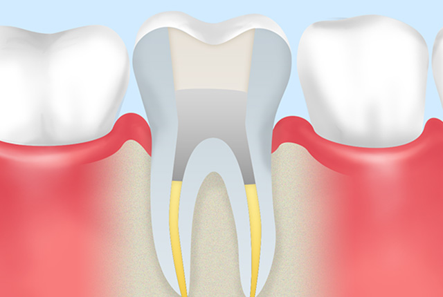 根管治療