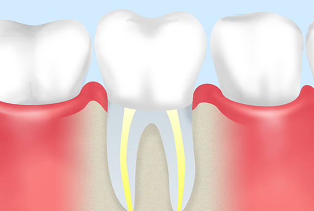 歯冠修復処置