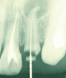 歯根端切除術