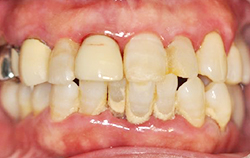 中等度の歯周病