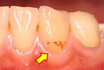 歯肉の肥厚（フェストゥーン）
