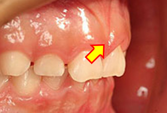歯肉の肥厚（フェストゥーン）