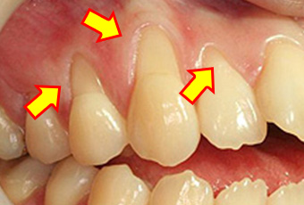 歯肉の退縮