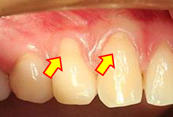 歯肉の退縮