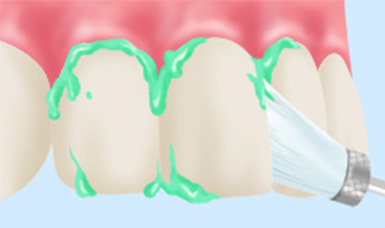 歯のクリーニング